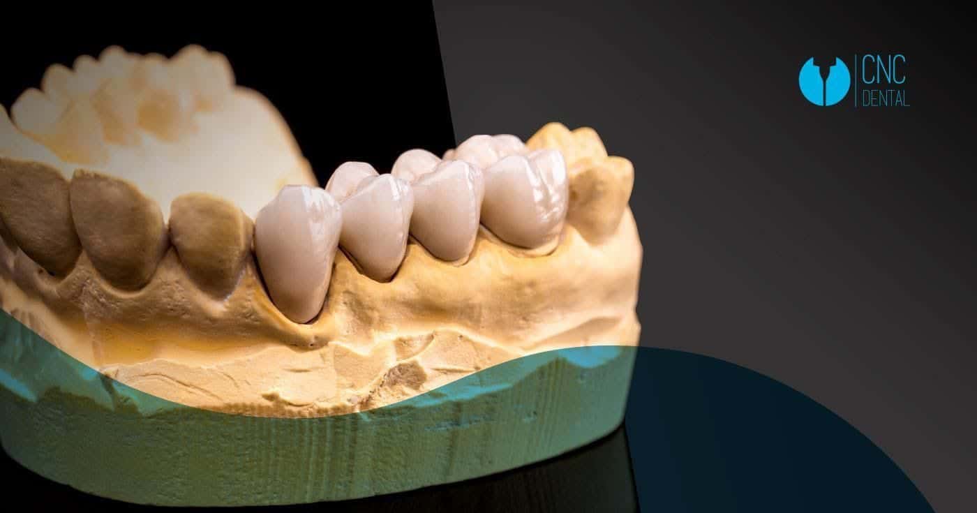 El zirconio, sus numerosas ventajas y su alta calidad obtienen acabados impecables en la fabricación de estructuras dentales.