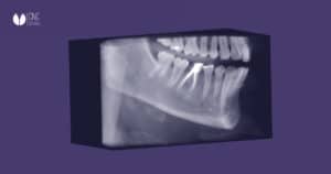 En CNC Dental revolucionamos el sector con el autoimplante dental gracias a los conocimientos avanzados y la impresión 3D