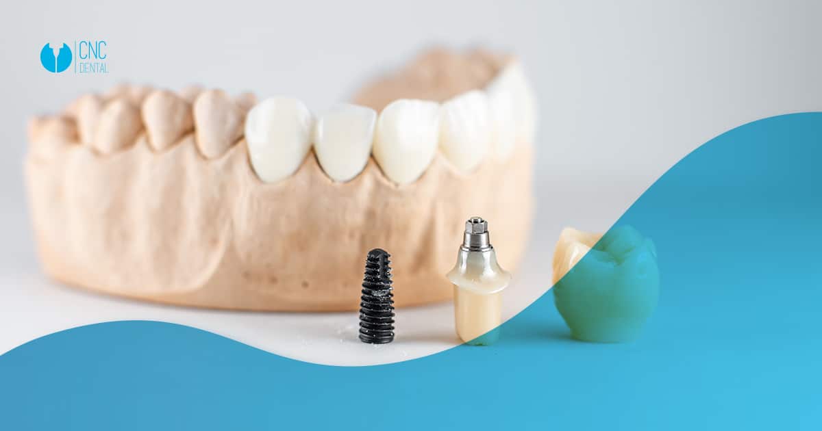 Es normal que te surjan cuestiones al plantearte la posibilidad de ponerte un implante dental. En CNC Dental queremos responderlas.
