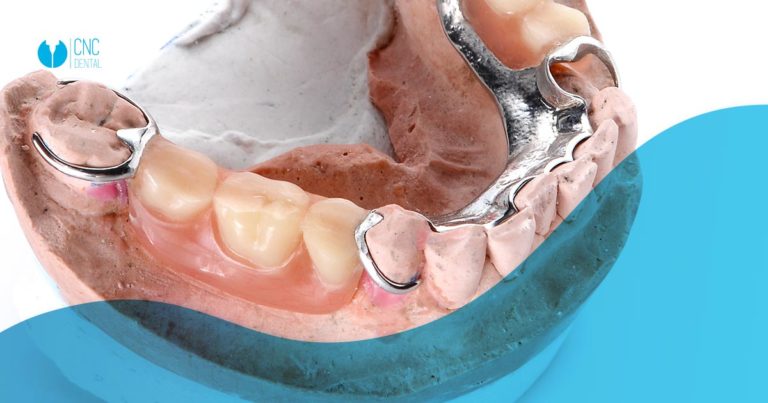 Prótesis Parciales Removibles ¿Cúando Se Suele Utilizar? - CNC Dental