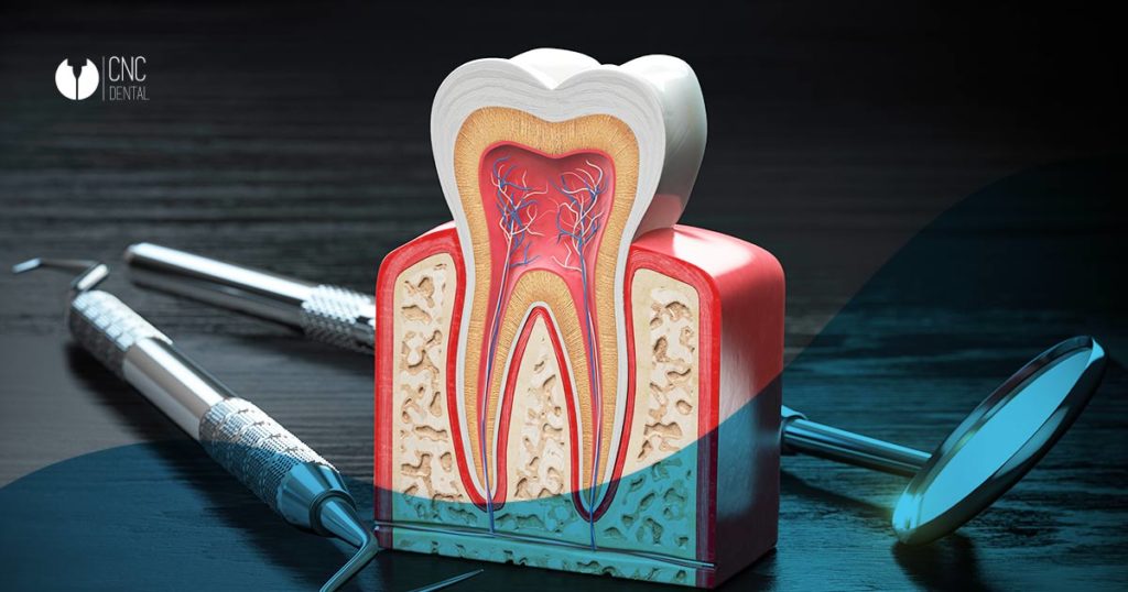 La férula dental es el mejor recurso para proteger la inversión de un implante dental. Descubre el motivo por el que deberías usarla
