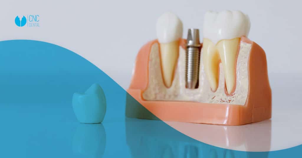 ¿Los implantes dentales me pueden dar problemas?