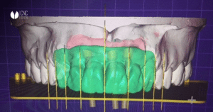 diseño-digital-protesis-dentales